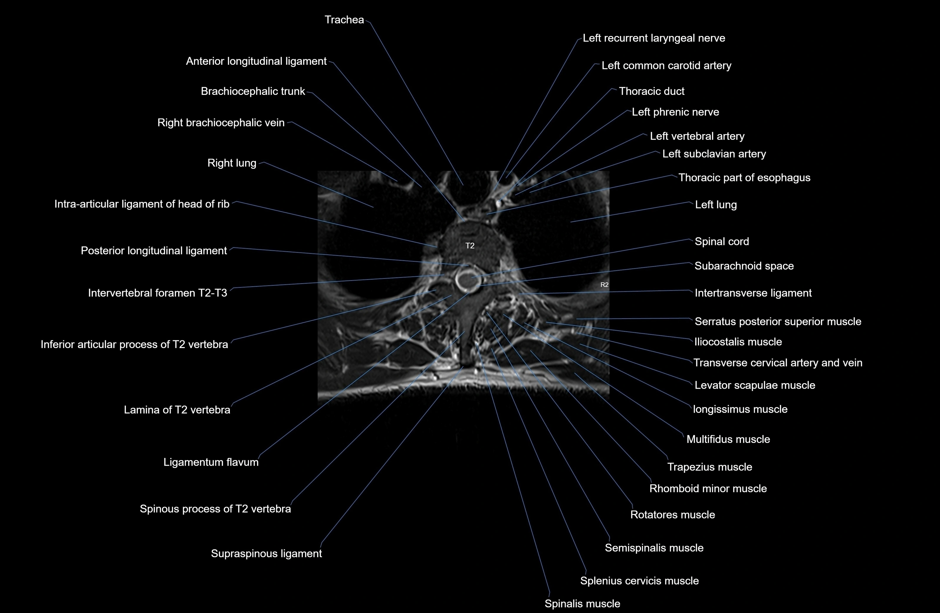 MRI thoracic spine axial  cross sectional anatomy 3T radiology  image-img-00001-00014.webp